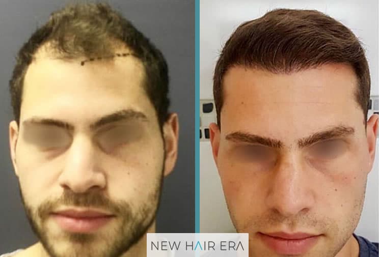 hair transplant result after one year